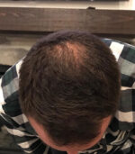After Have Hair Regrowth Spray