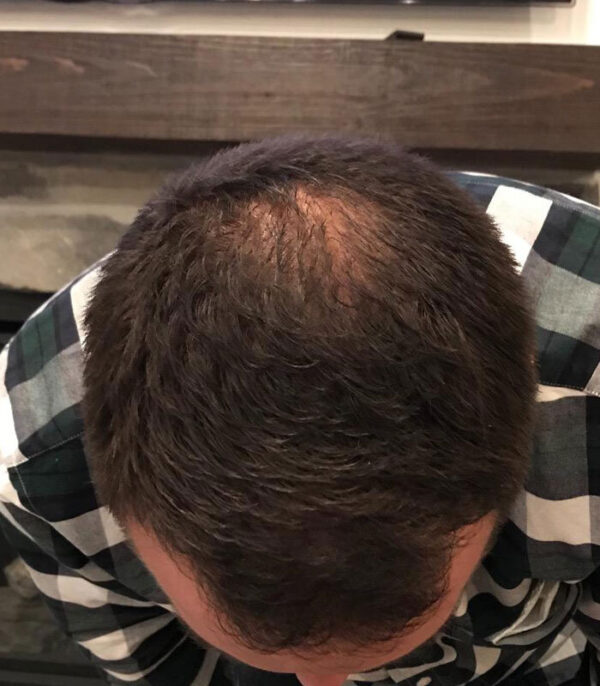 After Have Hair Regrowth Spray