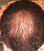 Before Have Hair Regrowth Spray